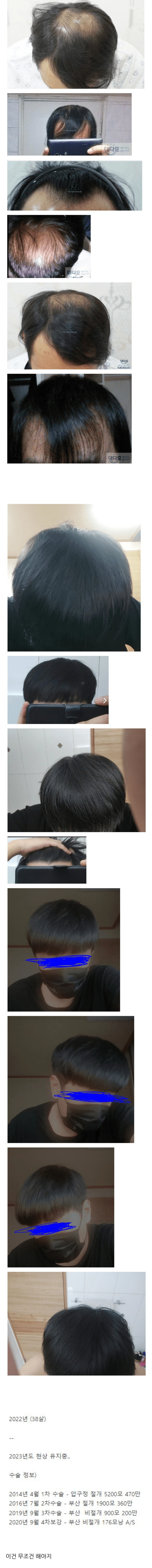 모발이식에 천만원 투자한 38살 결과물..jpg_1.webp