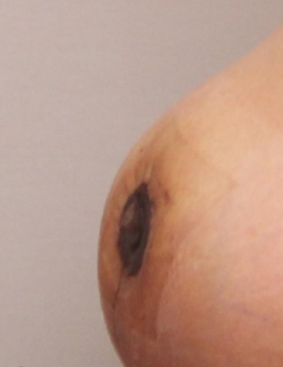 성형후기 및 성형주의사항(사진혐오 주의)