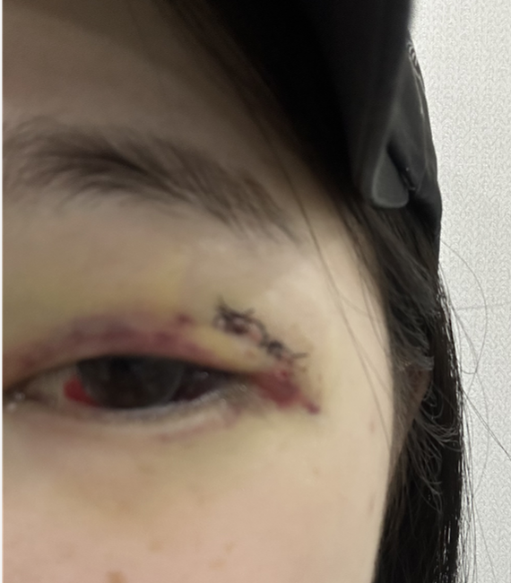 K대에서 딸아이는 왼쪽눈의 영구적 장애를 얻었습니다.