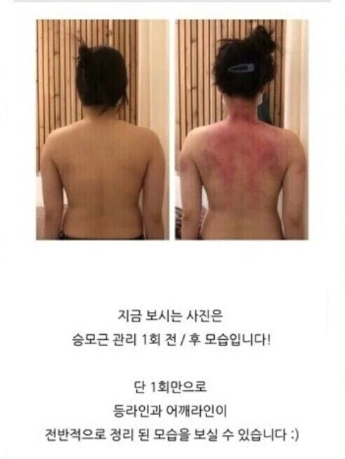 승모근 교정이 잘되는 이유 甲.jpg